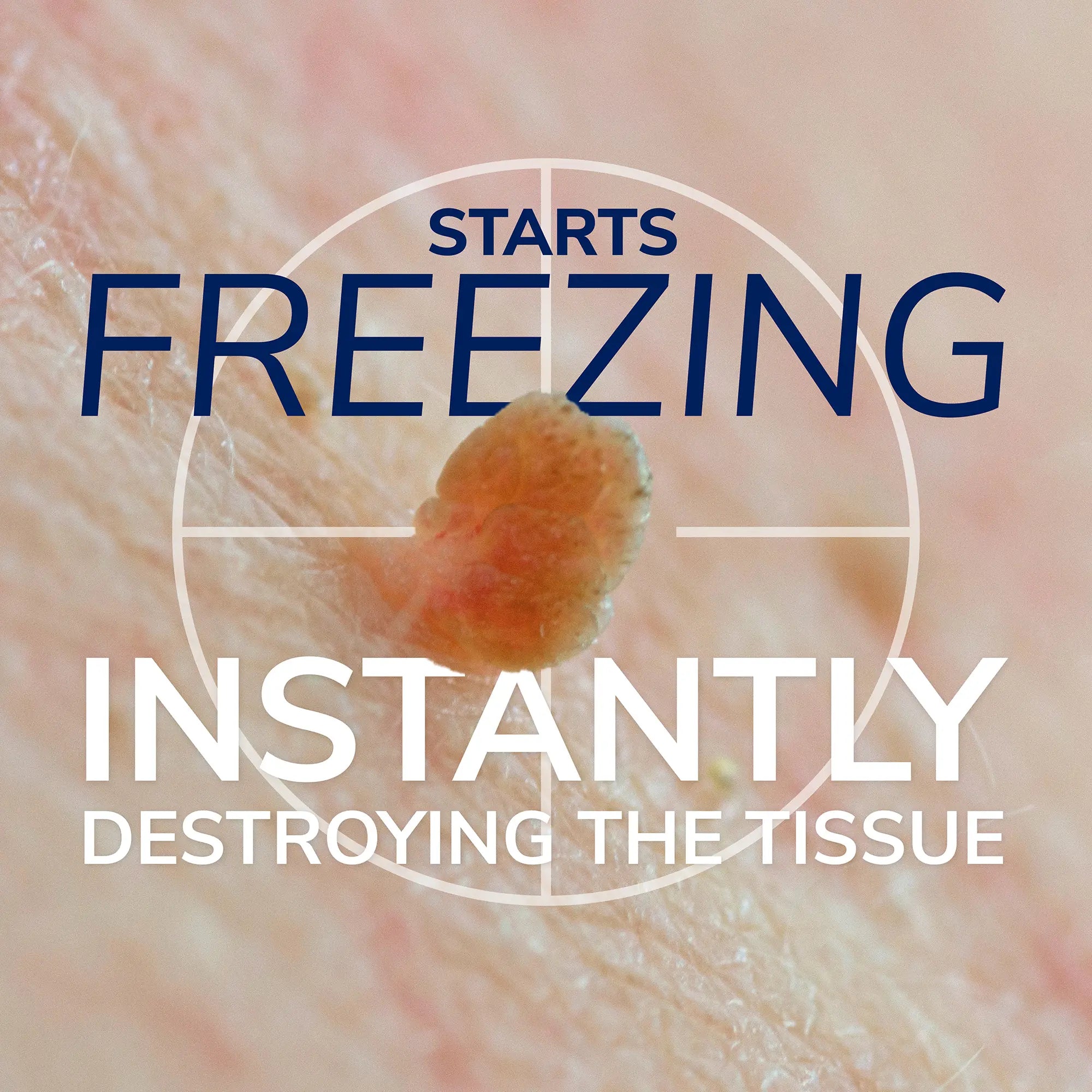 Freeze Away  Skin Tag Remover - Image 5